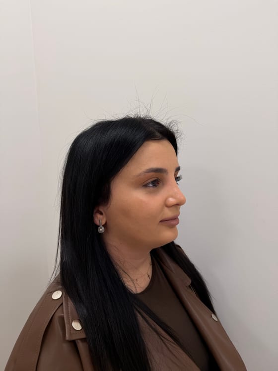 Результат ринопластики у пациента Dr. Harutyunyan