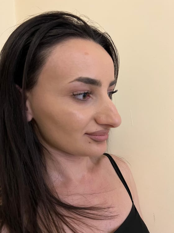 Результат ринопластики у пациента Dr. Harutyunyan
